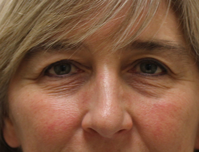 pensacola facial scar revision Pensacola facial scar revision