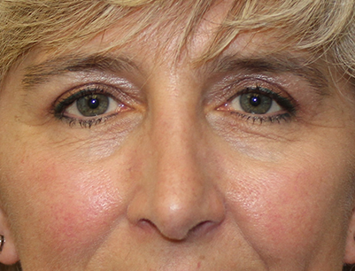 pensacola facial scar revision Pensacola facial scar revision