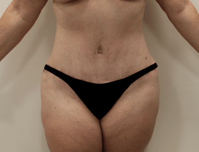 Patient 1482 Tummy Tuck, Breast Reduction, Mommy Makeover Before